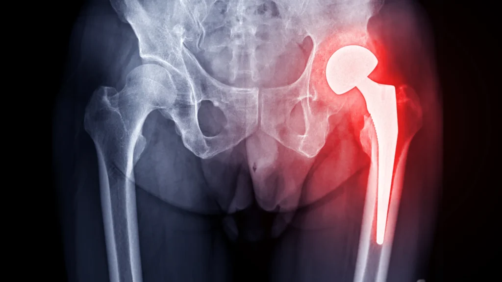 image radio d'une prothese de hanche